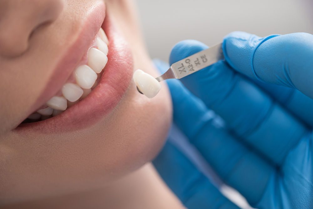 Dental Crown and Dental Bridges